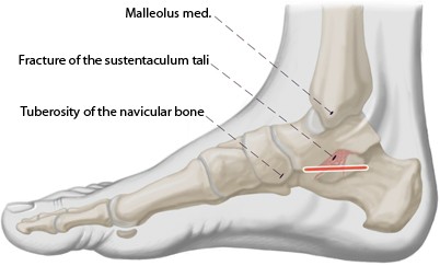 Sustentaculum Tali