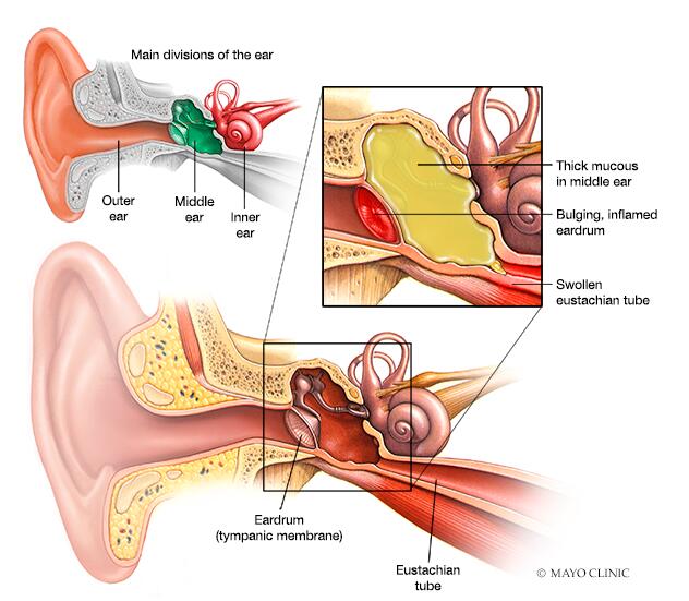 Ear infections